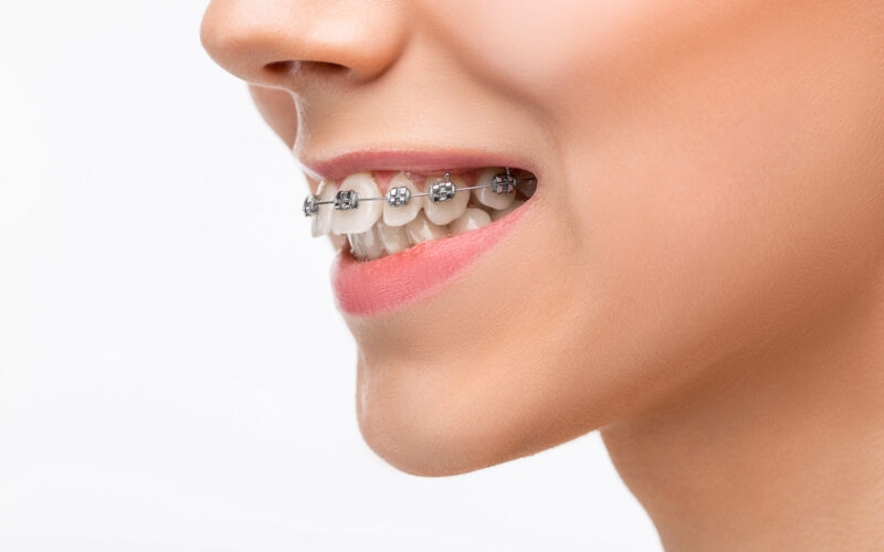 Best Orthodontic Braces Treatment in Wanowrie, Fatima Nagar Dr