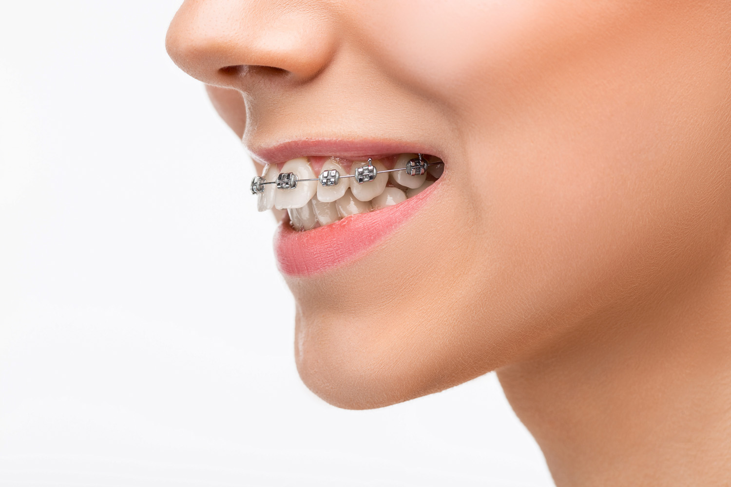 Best Orthodontic Braces Treatment in Wanowrie, Fatima Nagar Dr. Amruta Gotkhinde Ultra Care Best Orthodontic Braces Treatment in Wanowrie, Fatima Nagar Dr. Amruta Gotkhinde Ultra Care